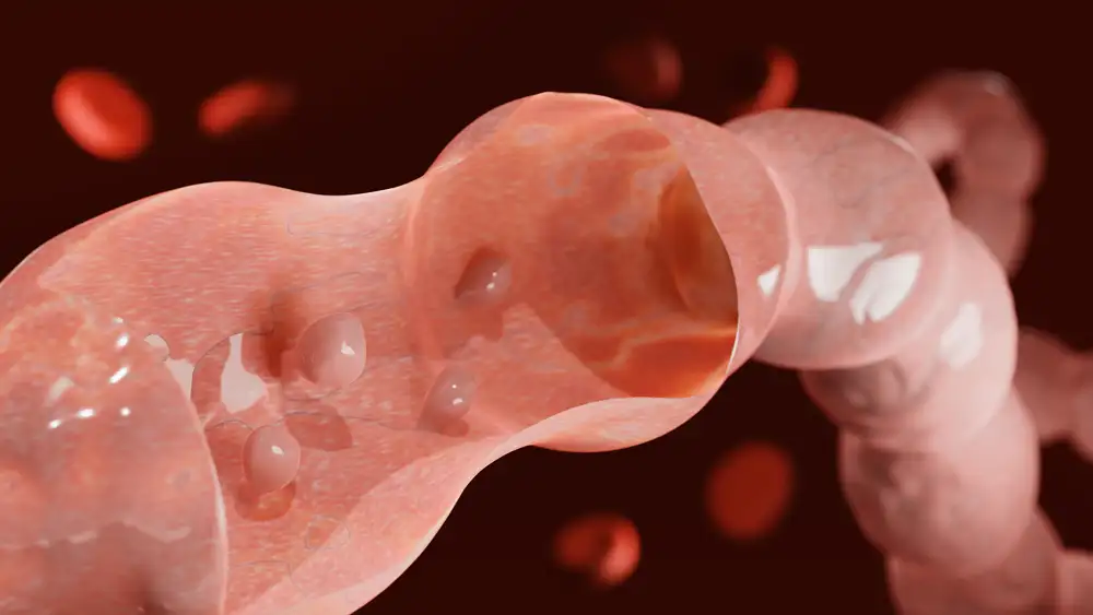 поліпи товстої кишки