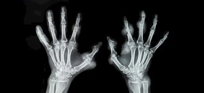 ревматоїдний артрит